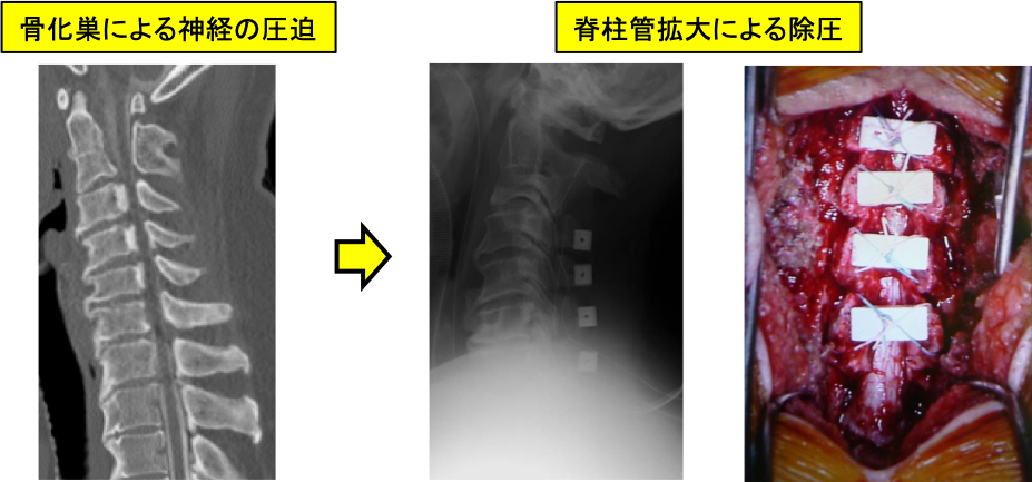 脊椎脊髄の手術 Ⅱ - 健康/医学